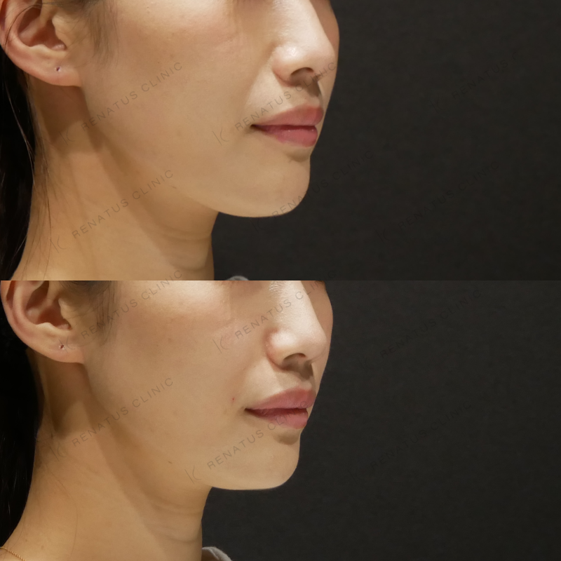 ほうれい線ヒアルロン酸ボリフト症例写真