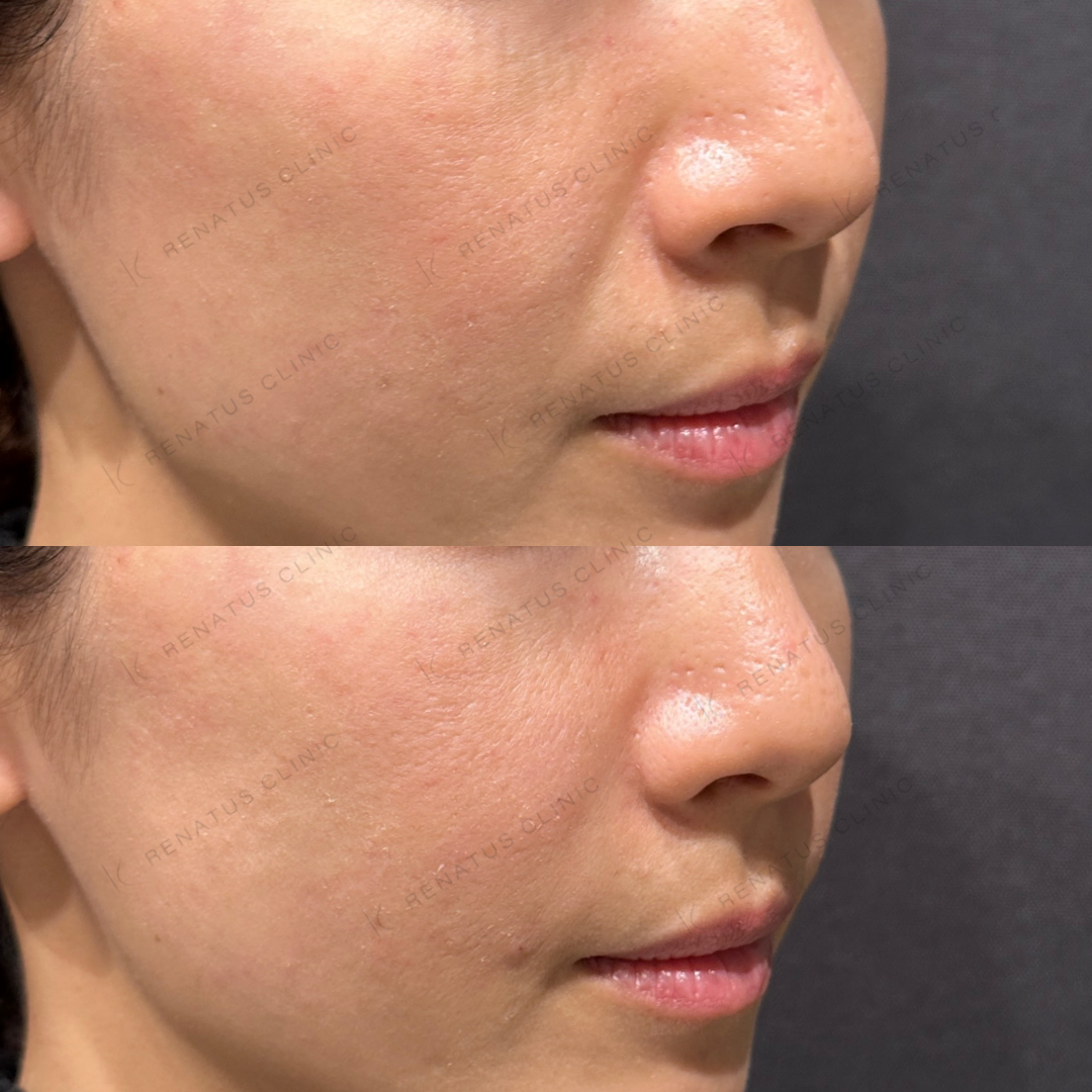 ほうれい線ヒアルロン酸ボリフト症例写真