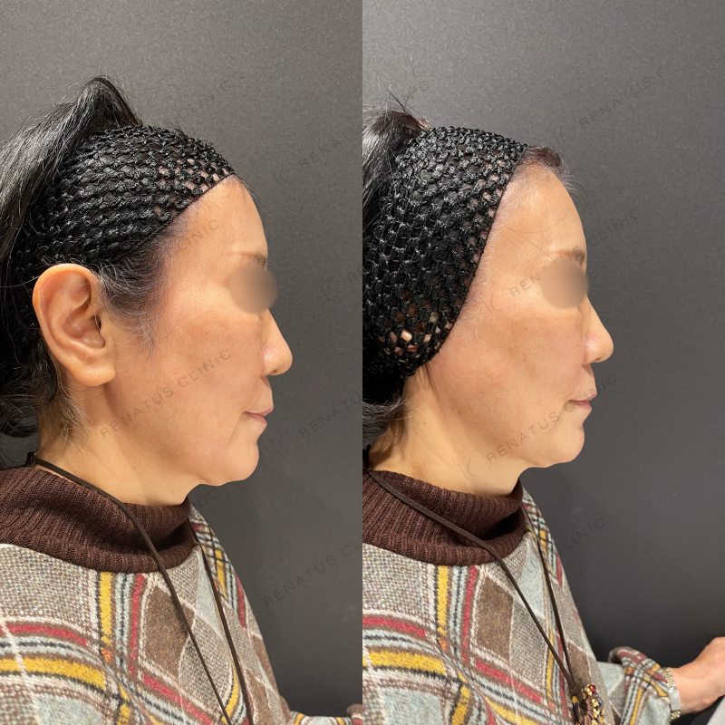 ほうれい線ヒアルロン酸ボリフト症例写真