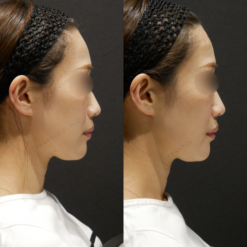 ほうれい線ヒアルロン酸ボリフト症例写真