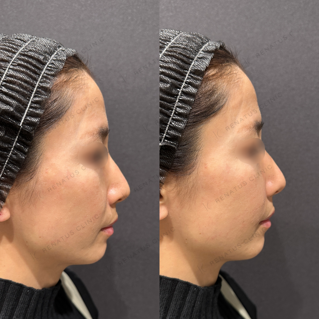 ほうれい線ヒアルロン酸ボリフト症例写真