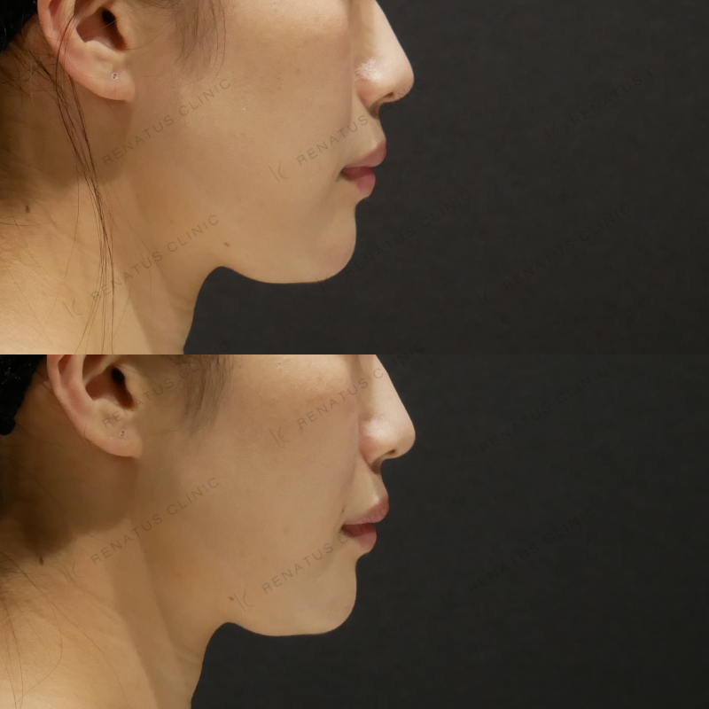 ほうれい線ヒアルロン酸ボリフト症例写真