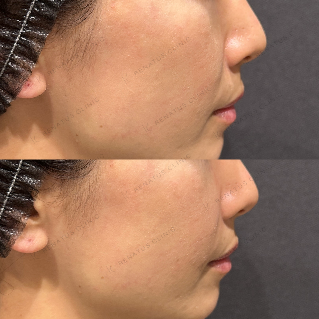 ほうれい線ヒアルロン酸ボリフト症例写真