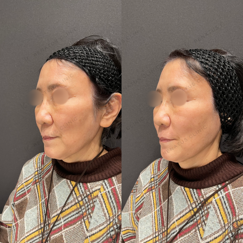 ほうれい線ヒアルロン酸ボリフト症例写真