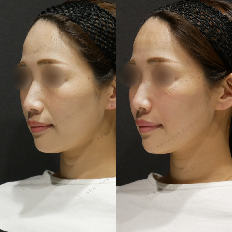 ほうれい線ヒアルロン酸ボリフト症例写真