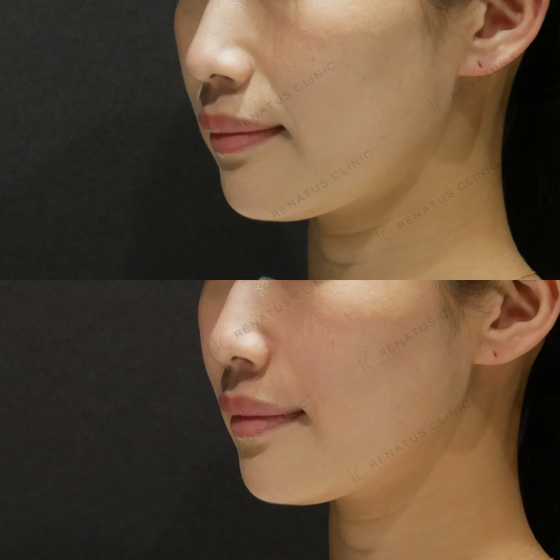 ほうれい線ヒアルロン酸ボリフト症例写真