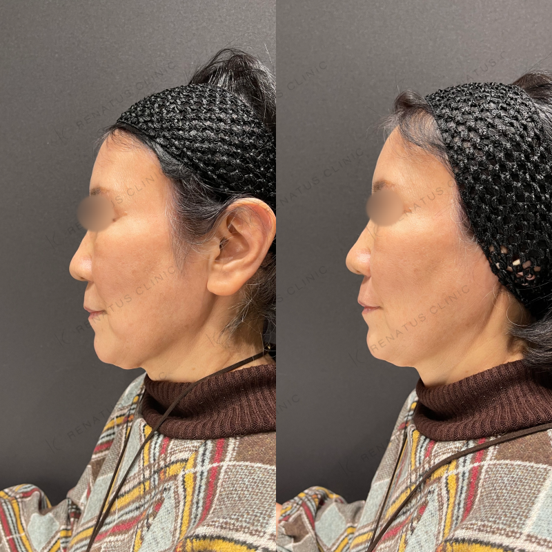 ほうれい線ヒアルロン酸ボリフト症例写真