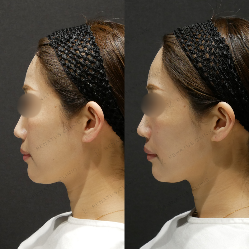 ほうれい線ヒアルロン酸ボリフト症例写真