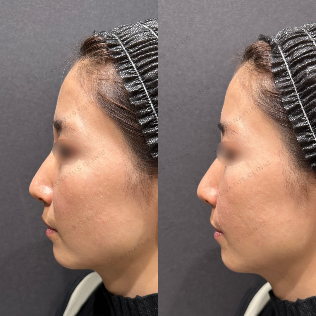 ほうれい線ヒアルロン酸ボリフト症例写真