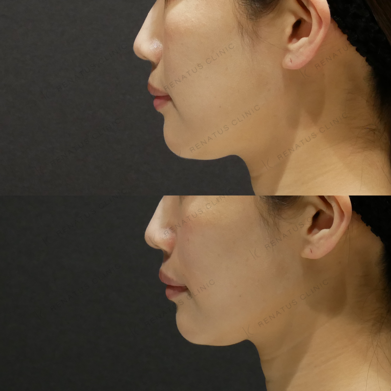 ほうれい線ヒアルロン酸ボリフト症例写真