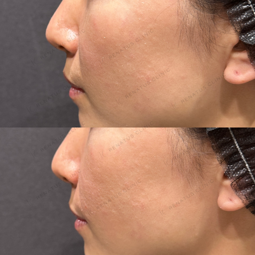 ほうれい線ヒアルロン酸ボリフト症例写真