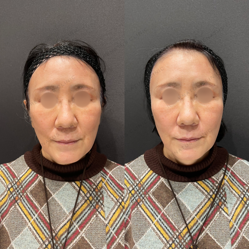 ほうれい線ヒアルロン酸ボリフト症例写真