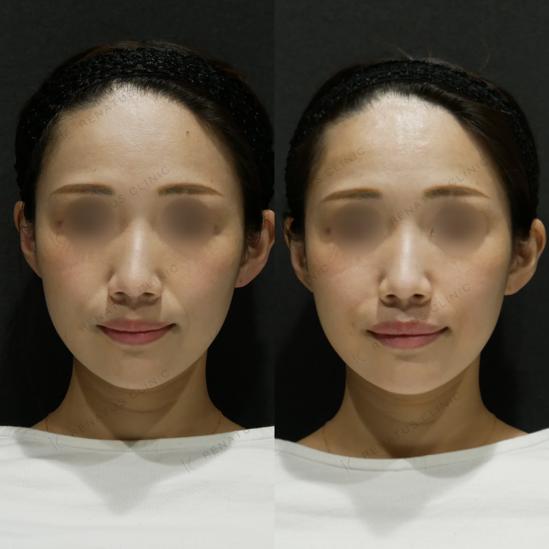 ほうれい線ヒアルロン酸ボリフト症例写真