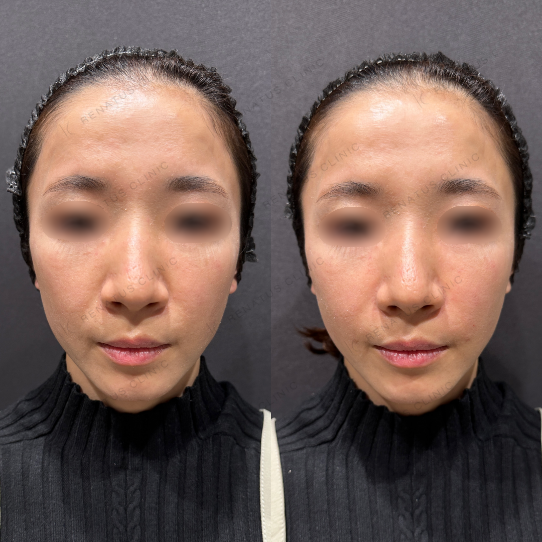 ほうれい線ヒアルロン酸ボリフト症例写真