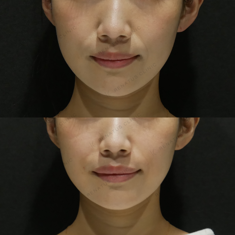 ほうれい線ヒアルロン酸ボリフト症例写真