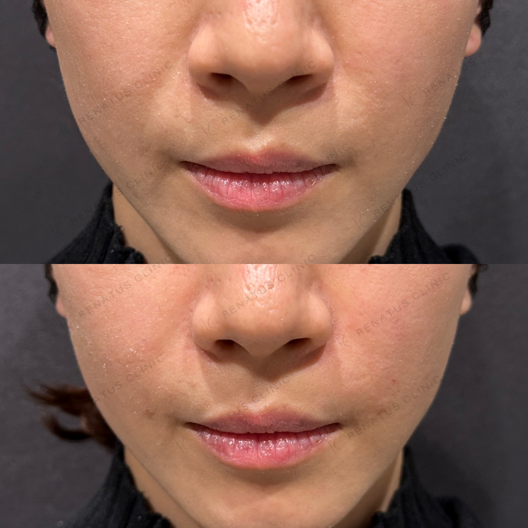 ほうれい線ヒアルロン酸ボリフト症例写真