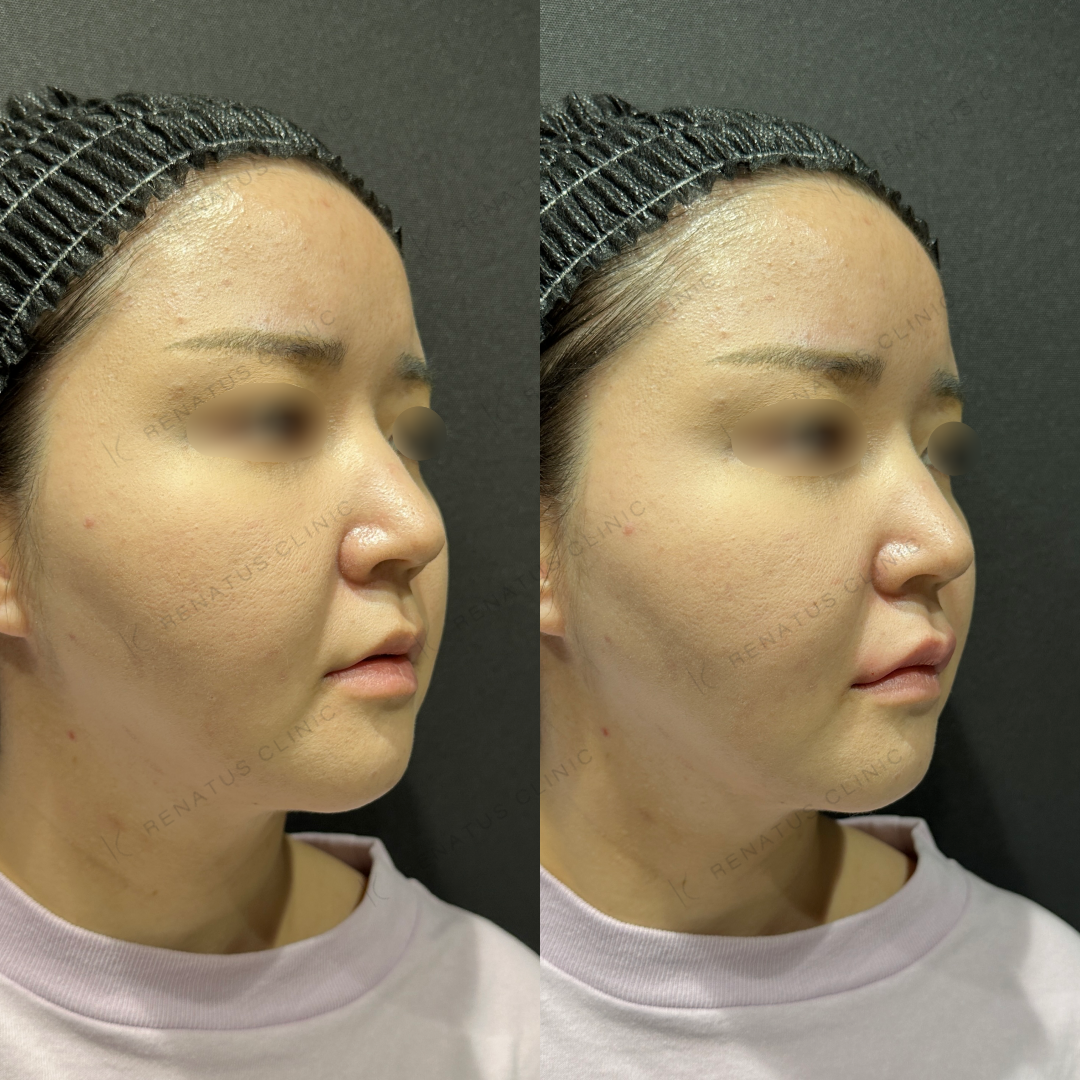 上唇ヒアルロン酸ボルベラ症例写真