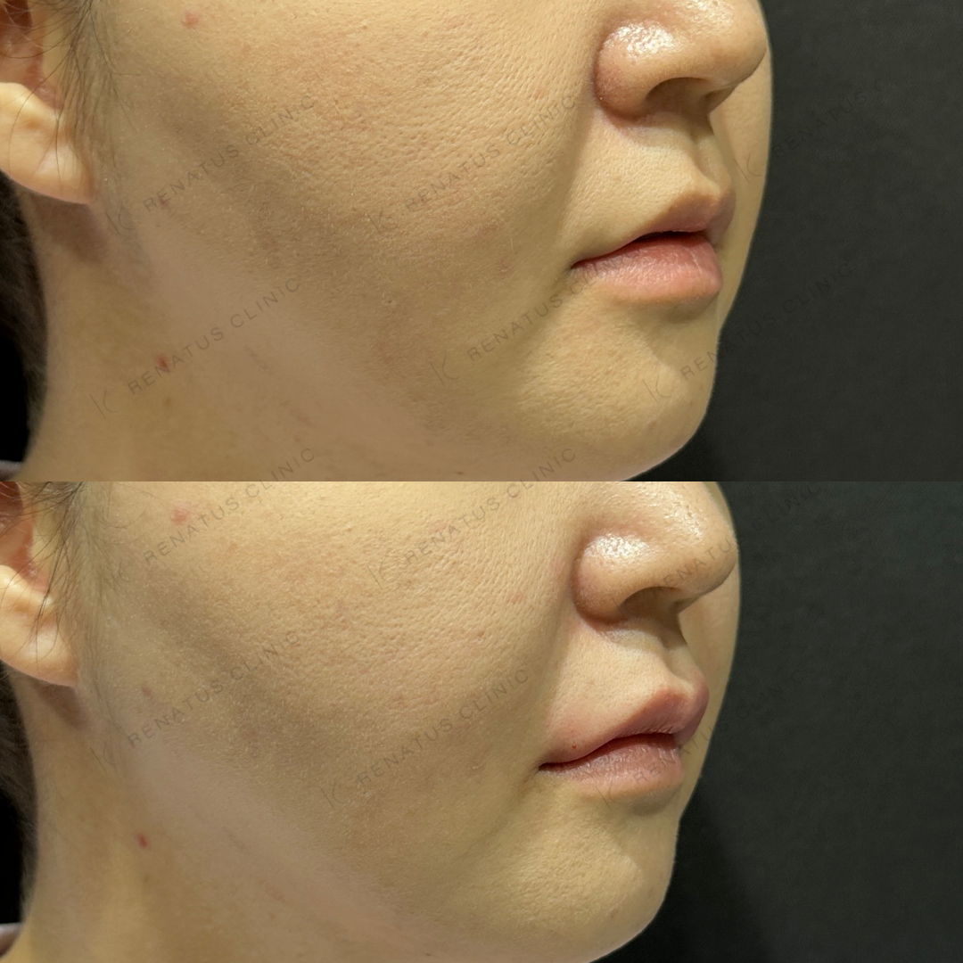 上唇ヒアルロン酸ボルベラ症例写真