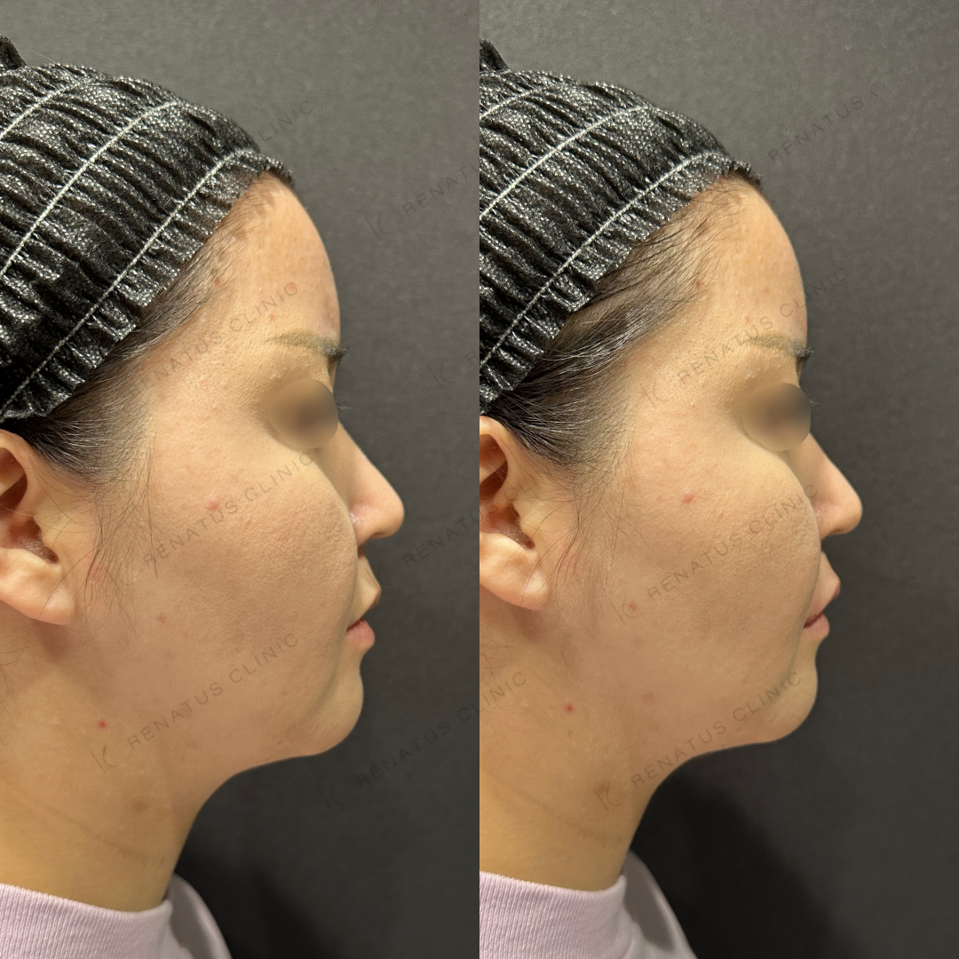 上唇ヒアルロン酸ボルベラ症例写真