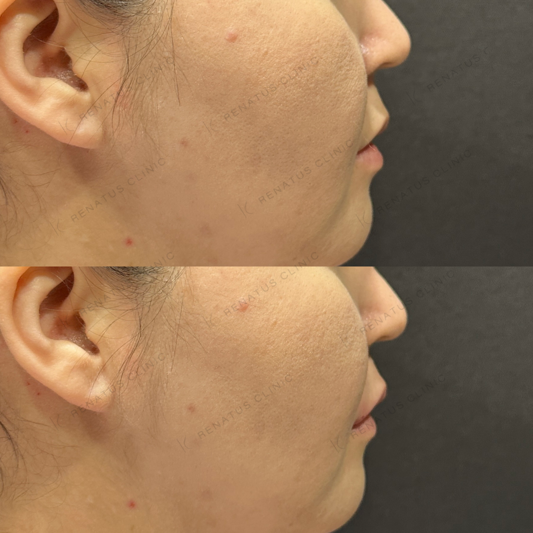 上唇ヒアルロン酸ボルベラ症例写真