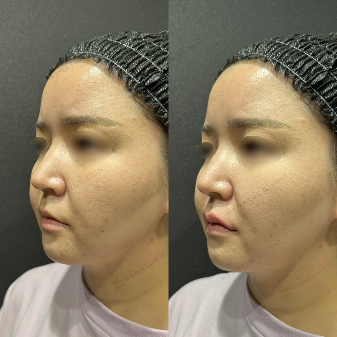 上唇ヒアルロン酸ボルベラ症例写真