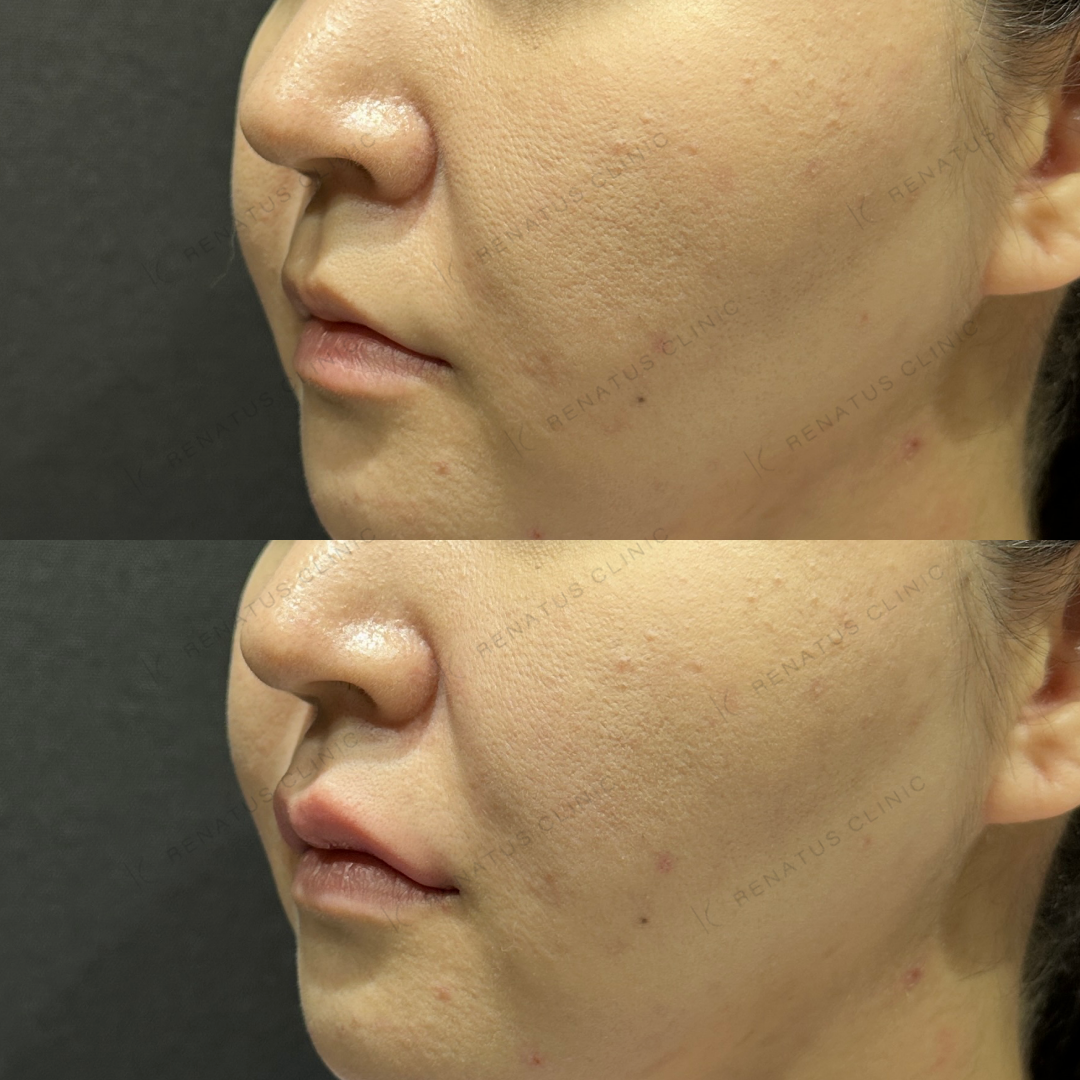 上唇ヒアルロン酸ボルベラ症例写真