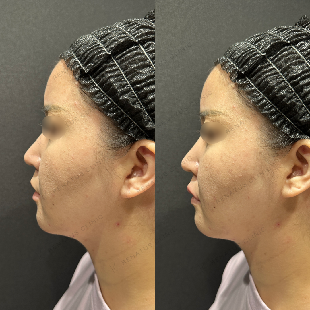 上唇ヒアルロン酸ボルベラ症例写真