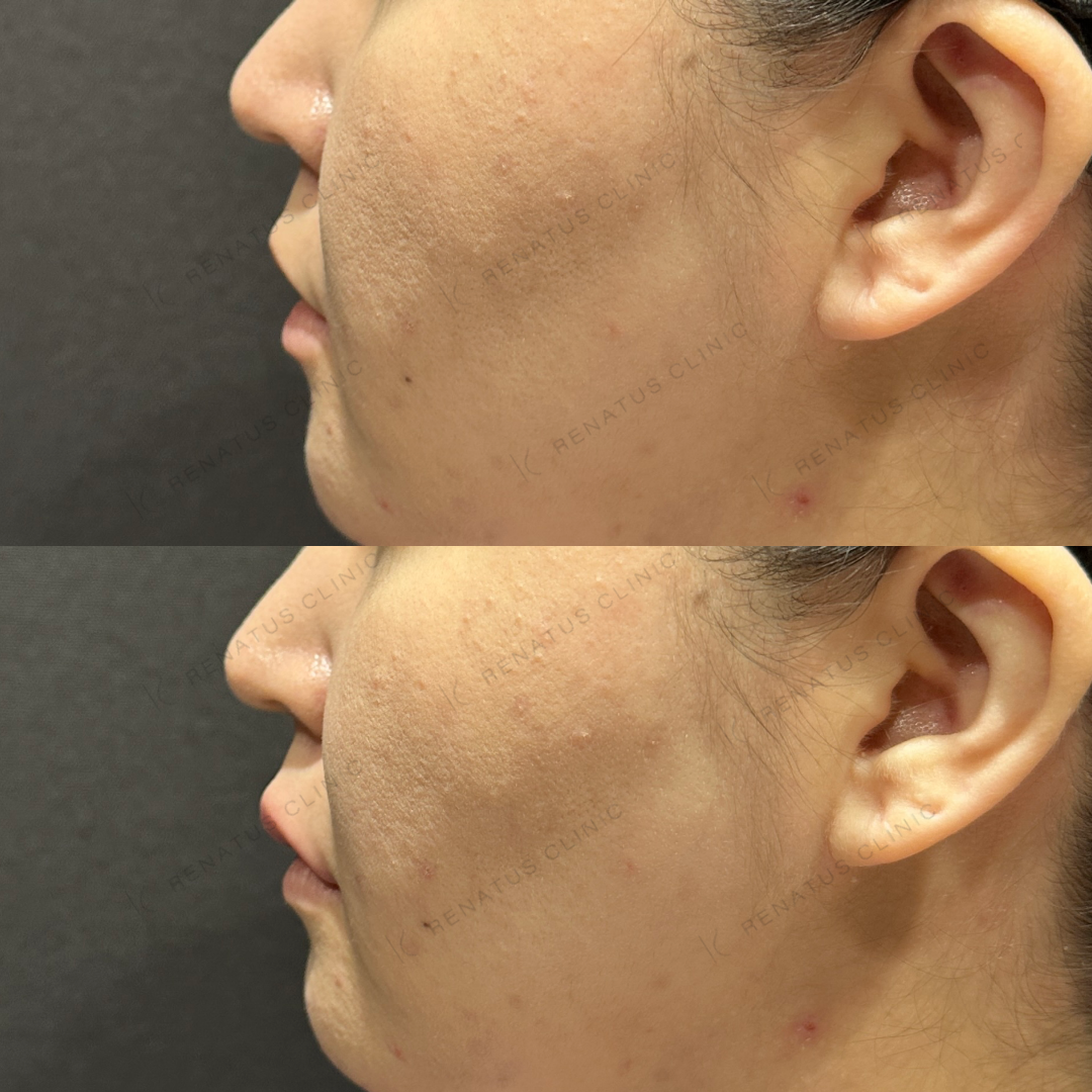 上唇ヒアルロン酸ボルベラ症例写真