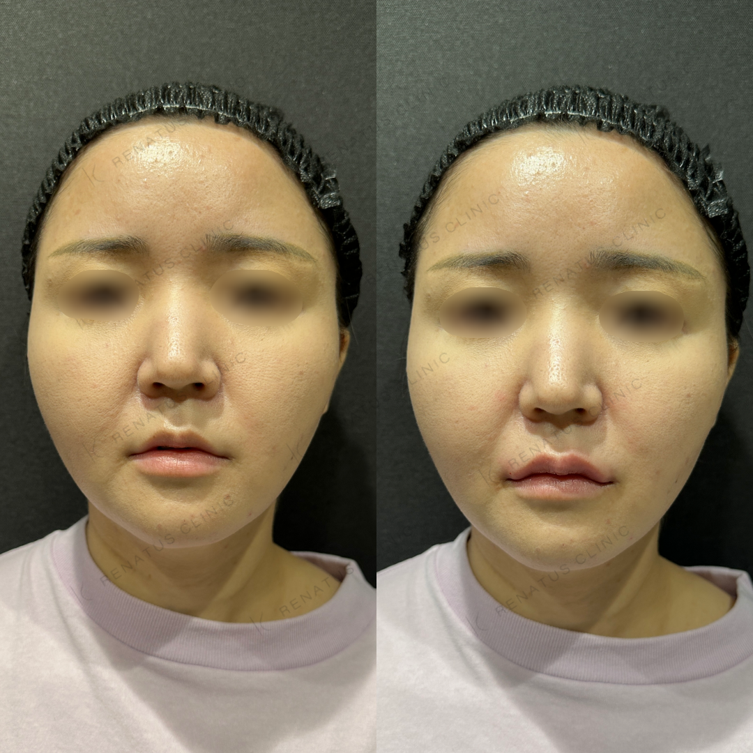 上唇ヒアルロン酸ボルベラ症例写真