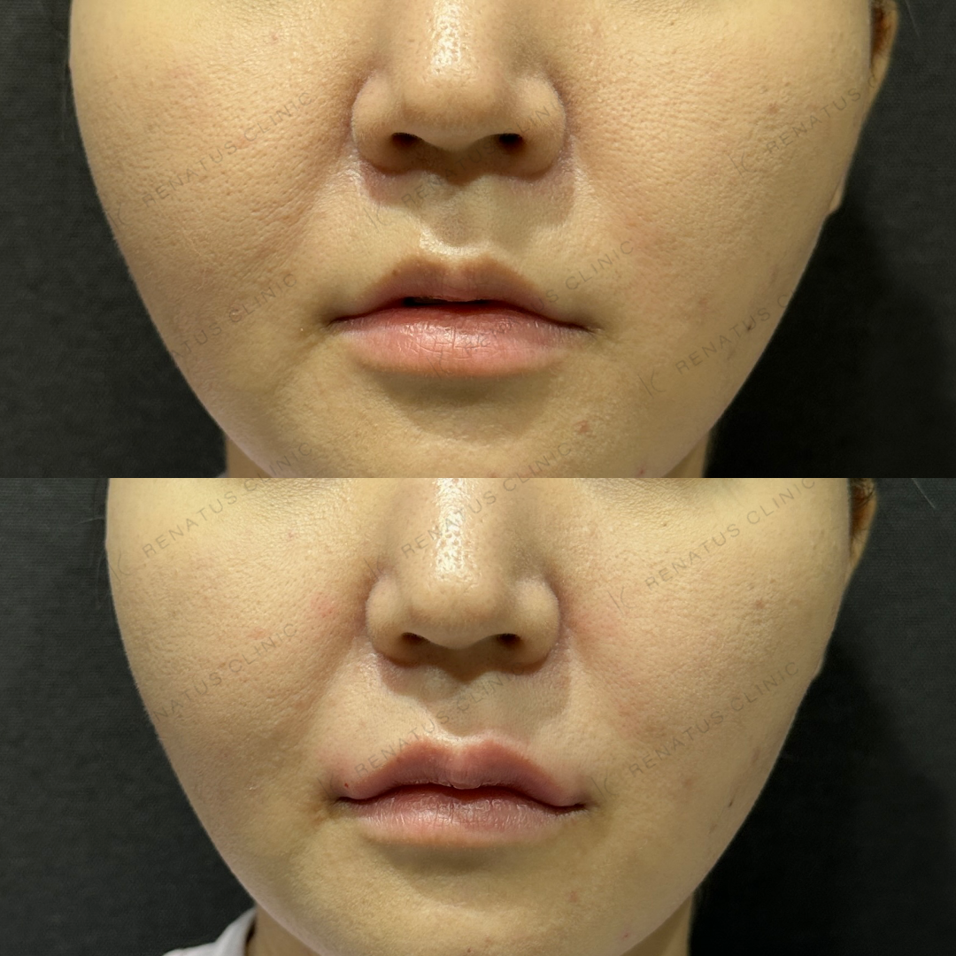 上唇ヒアルロン酸ボルベラ症例写真