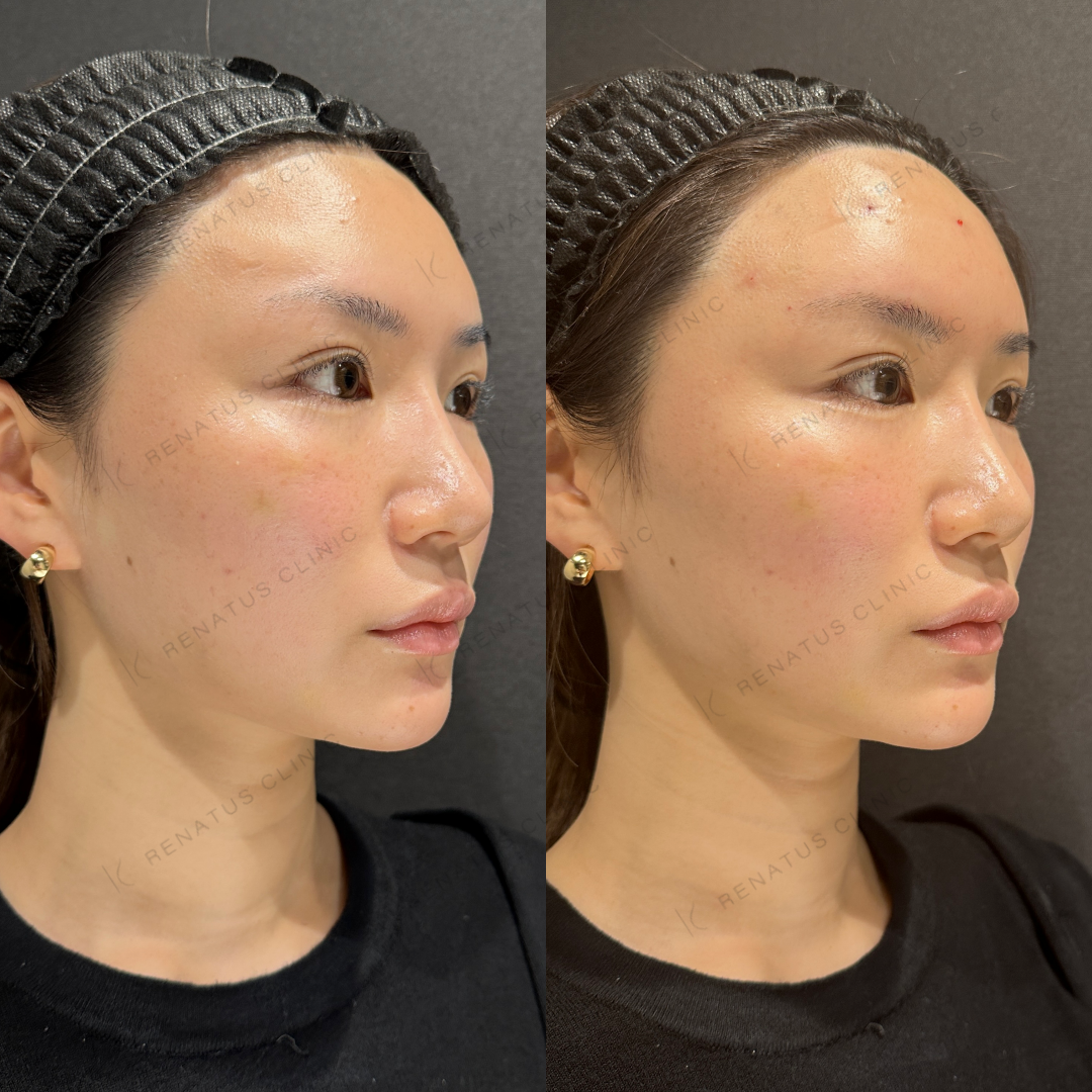 額ヒアルロン酸ボリューマ症例写真