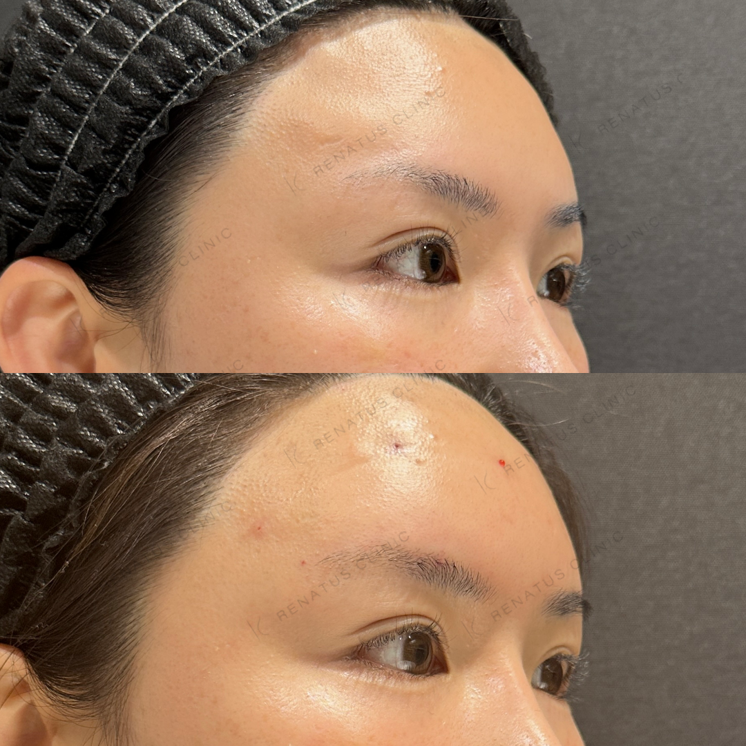 額ヒアルロン酸ボリューマ症例写真