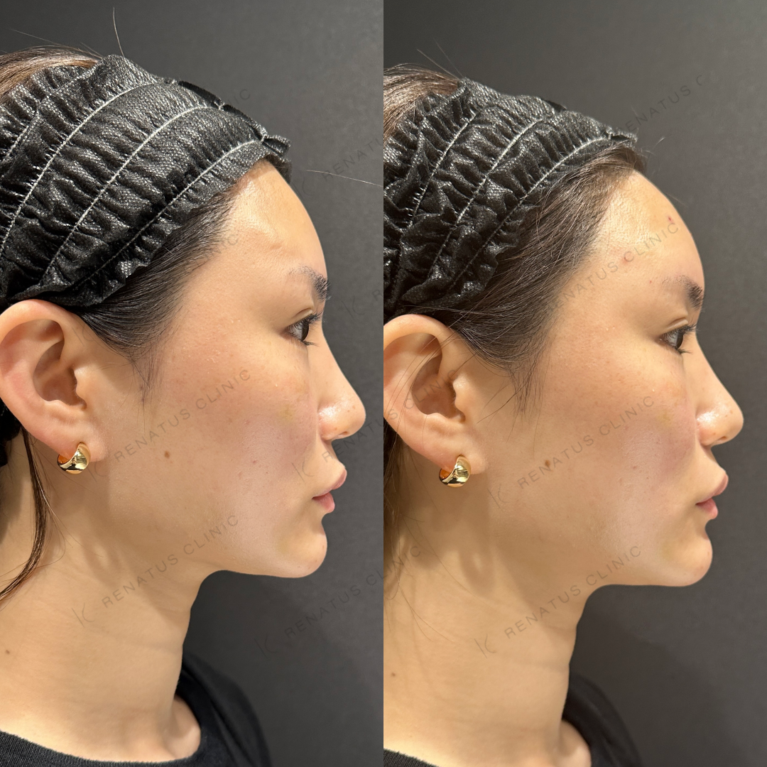 額ヒアルロン酸ボリューマ症例写真