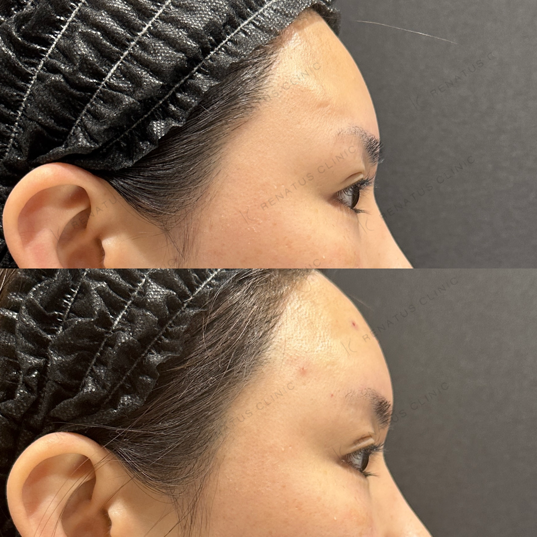 額ヒアルロン酸ボリューマ症例写真