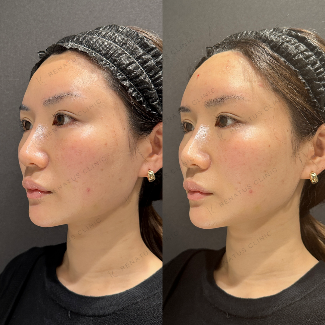 額ヒアルロン酸ボリューマ症例写真