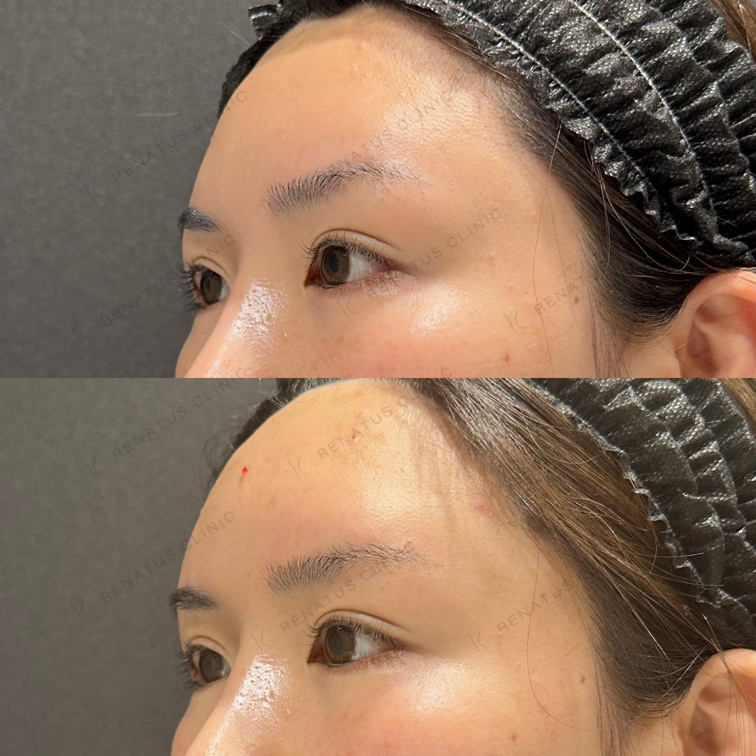 額ヒアルロン酸ボリューマ症例写真