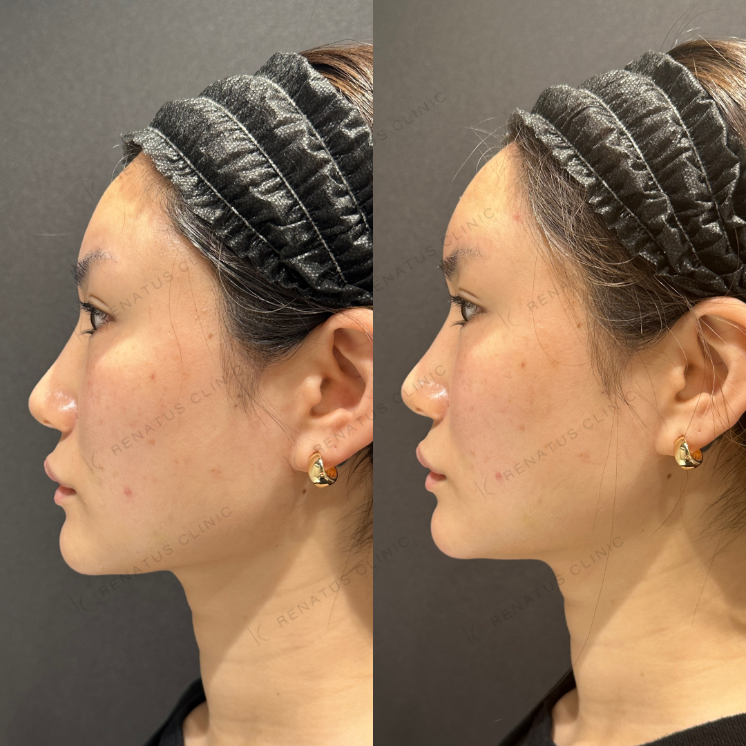 額ヒアルロン酸ボリューマ症例写真