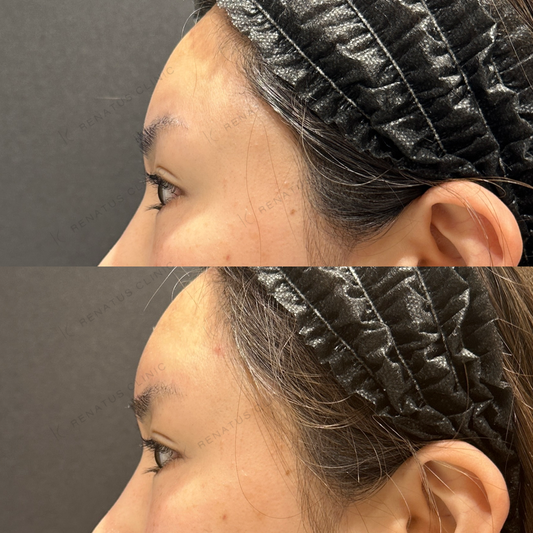 額ヒアルロン酸ボリューマ症例写真