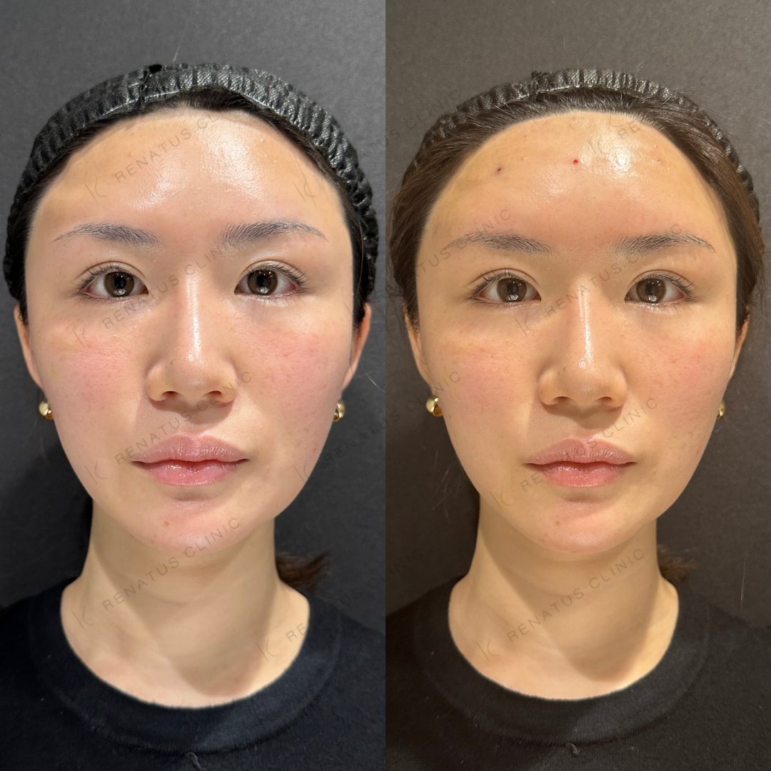 額ヒアルロン酸ボリューマ症例写真