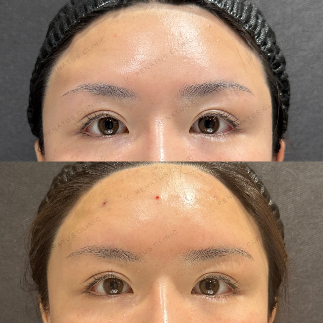 額ヒアルロン酸ボリューマ症例写真