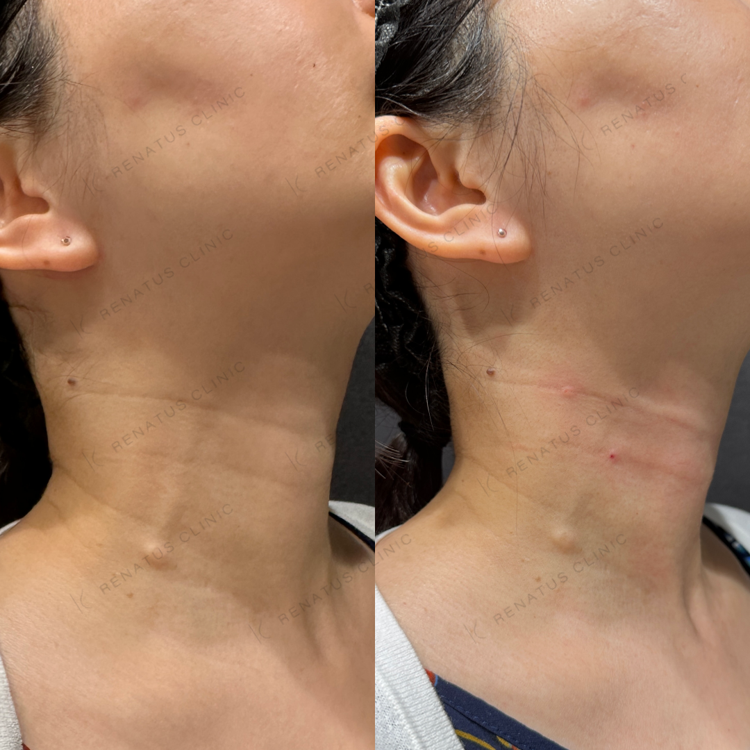 首ヒアルロン酸ボライト症例写真