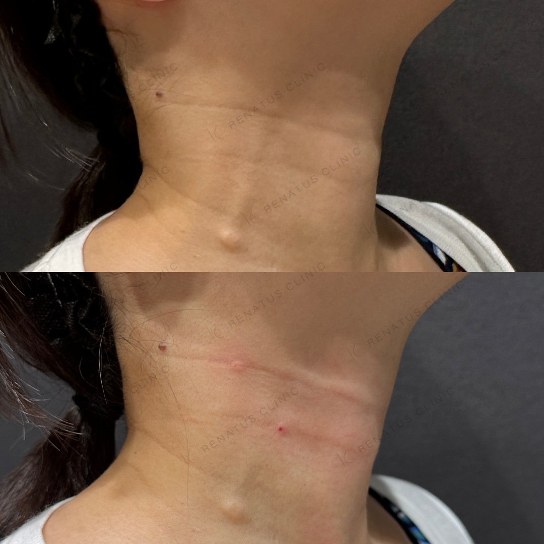 首ヒアルロン酸ボライト症例写真