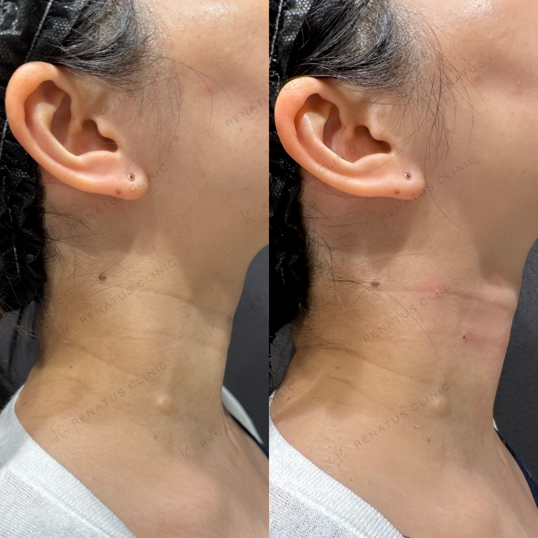 首ヒアルロン酸ボライト症例写真