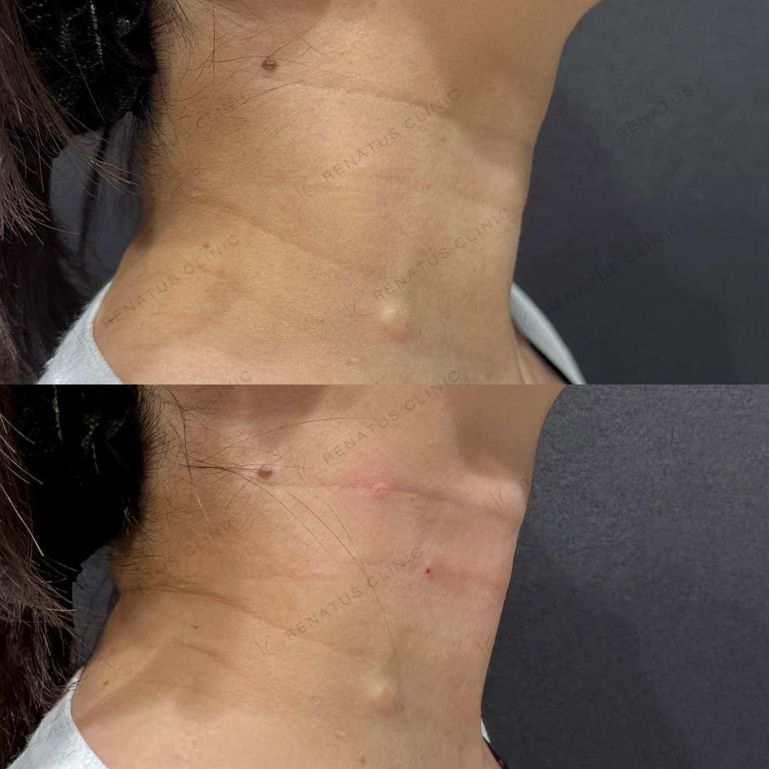 首ヒアルロン酸ボライト症例写真