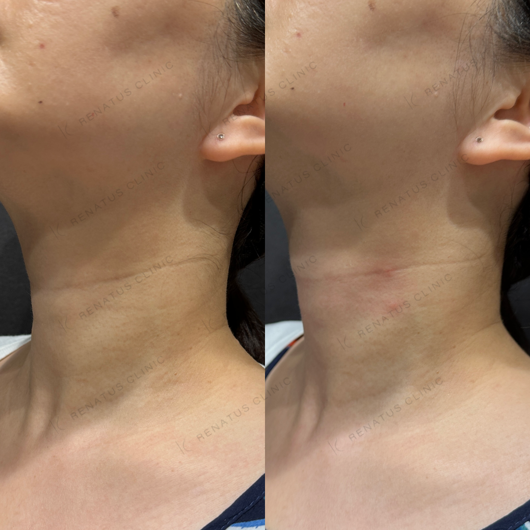 首ヒアルロン酸ボライト症例写真