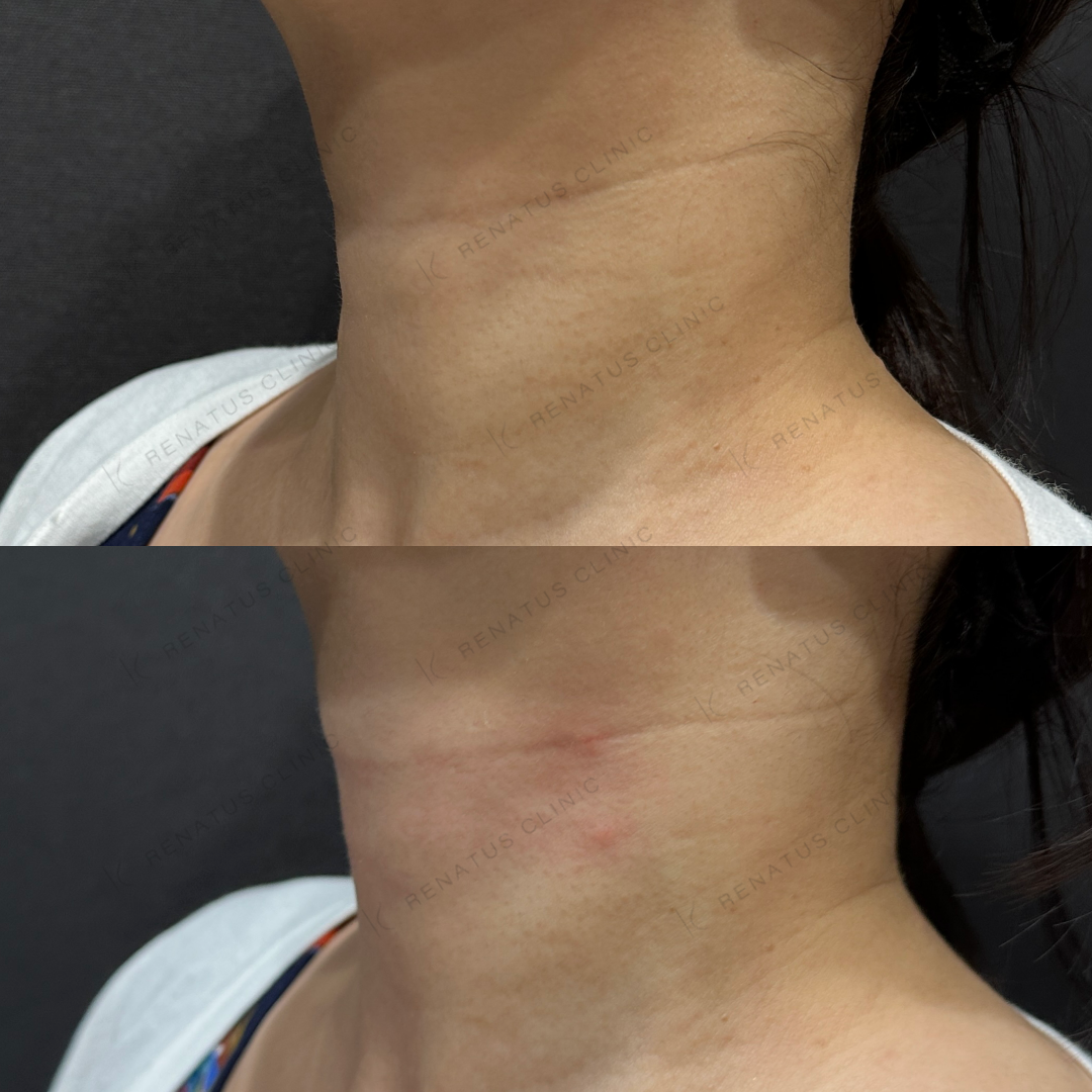 首ヒアルロン酸ボライト症例写真