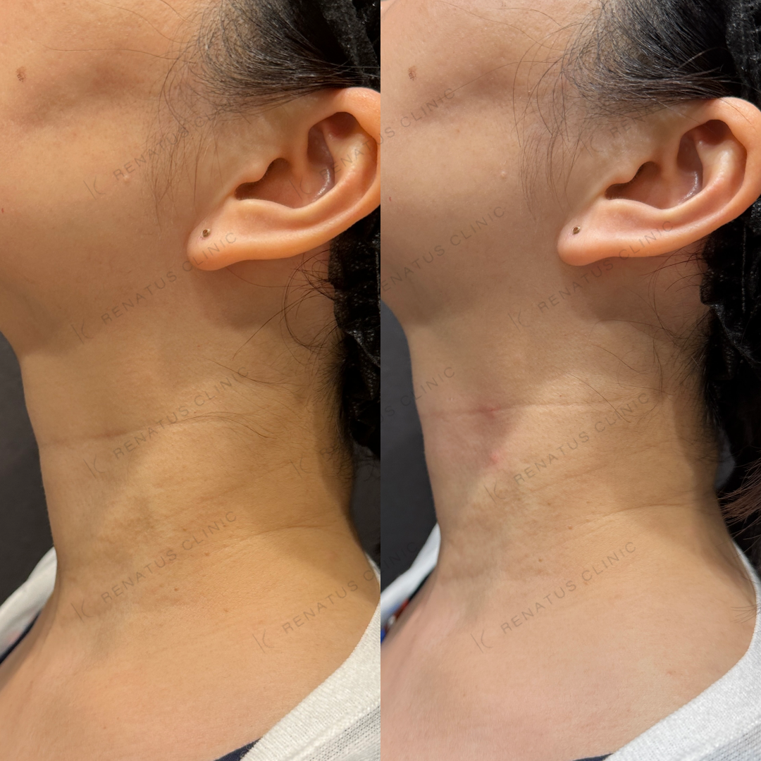 首ヒアルロン酸ボライト症例写真