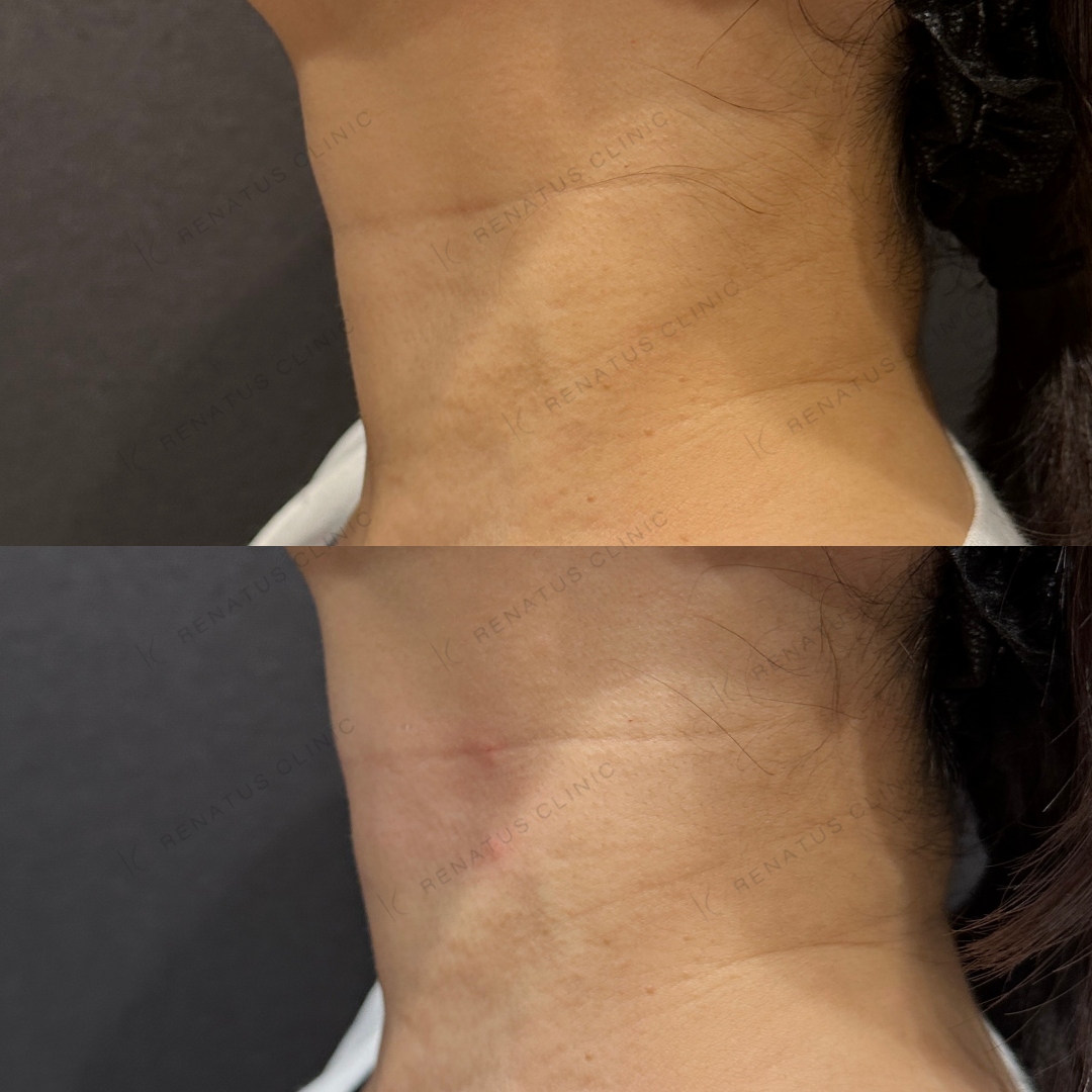 首ヒアルロン酸ボライト症例写真