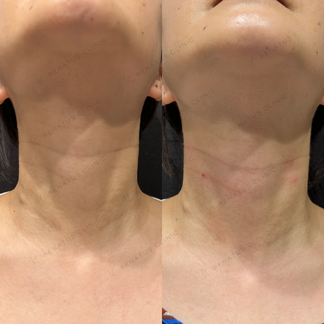 首ヒアルロン酸ボライト症例写真