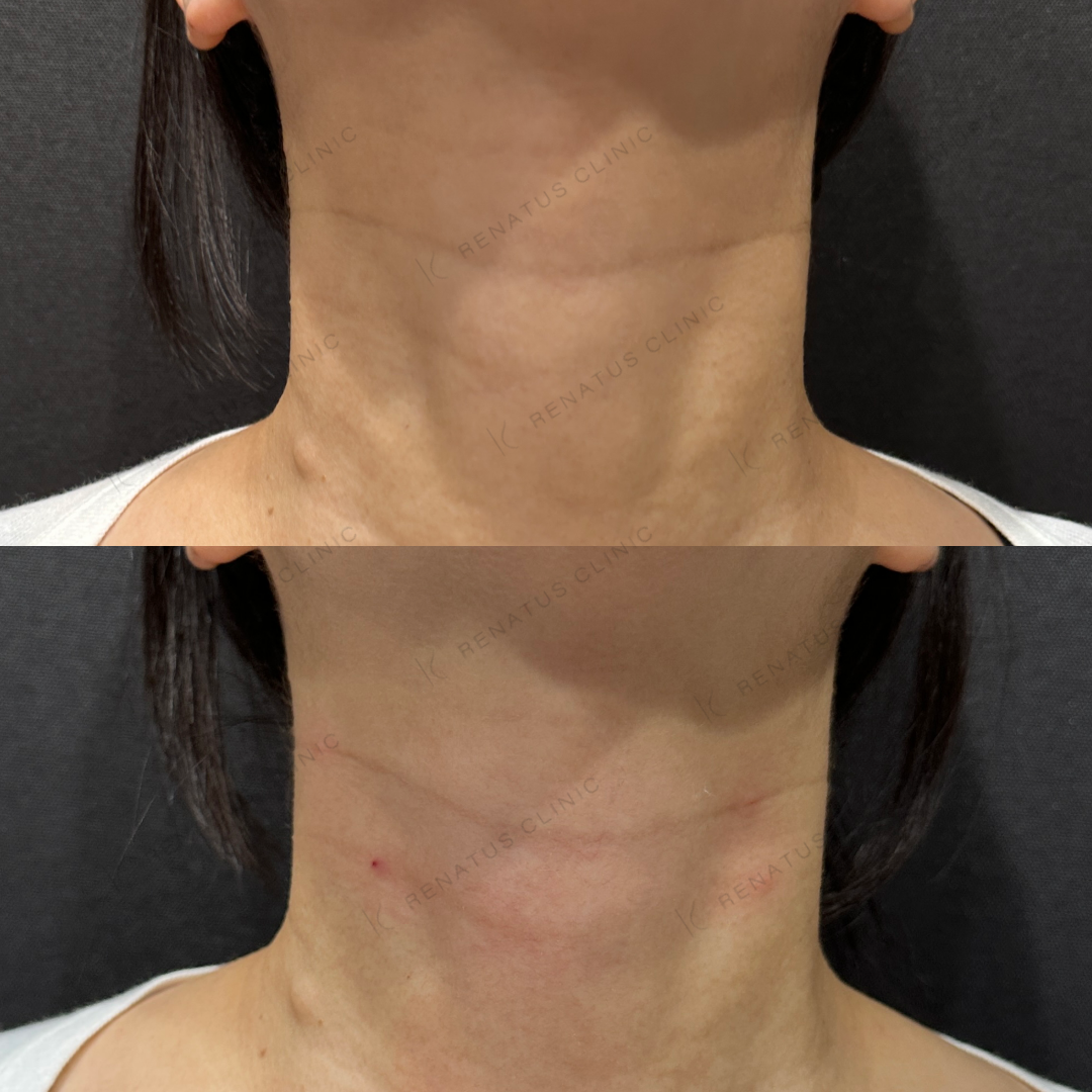 首ヒアルロン酸ボライト症例写真